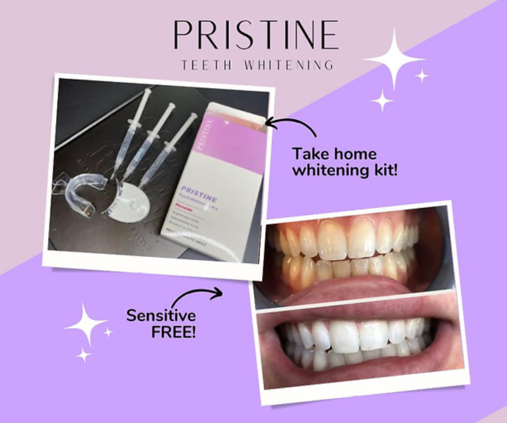 Home Whitening Kits