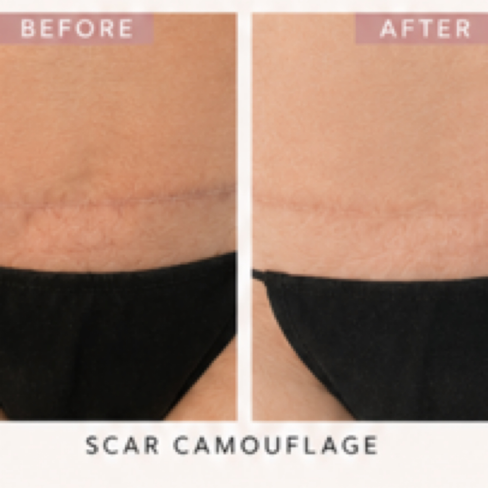 Medium Scar Camouflage at Skin Theory Collective in Port Richey, FL