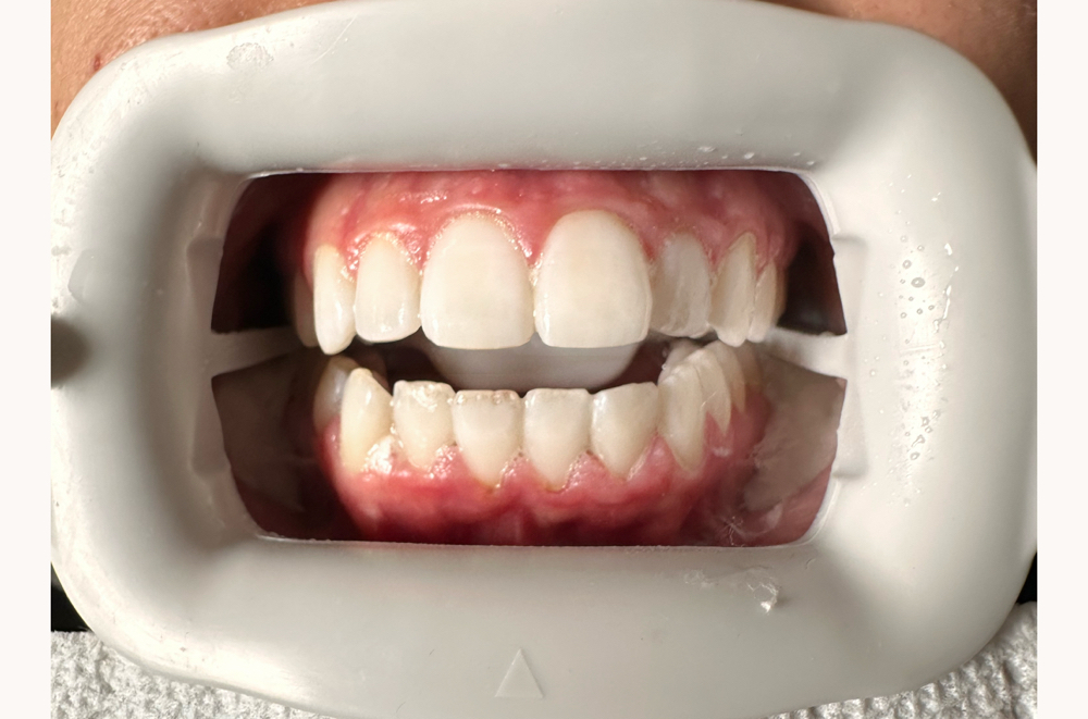 Tooth Gem Removal