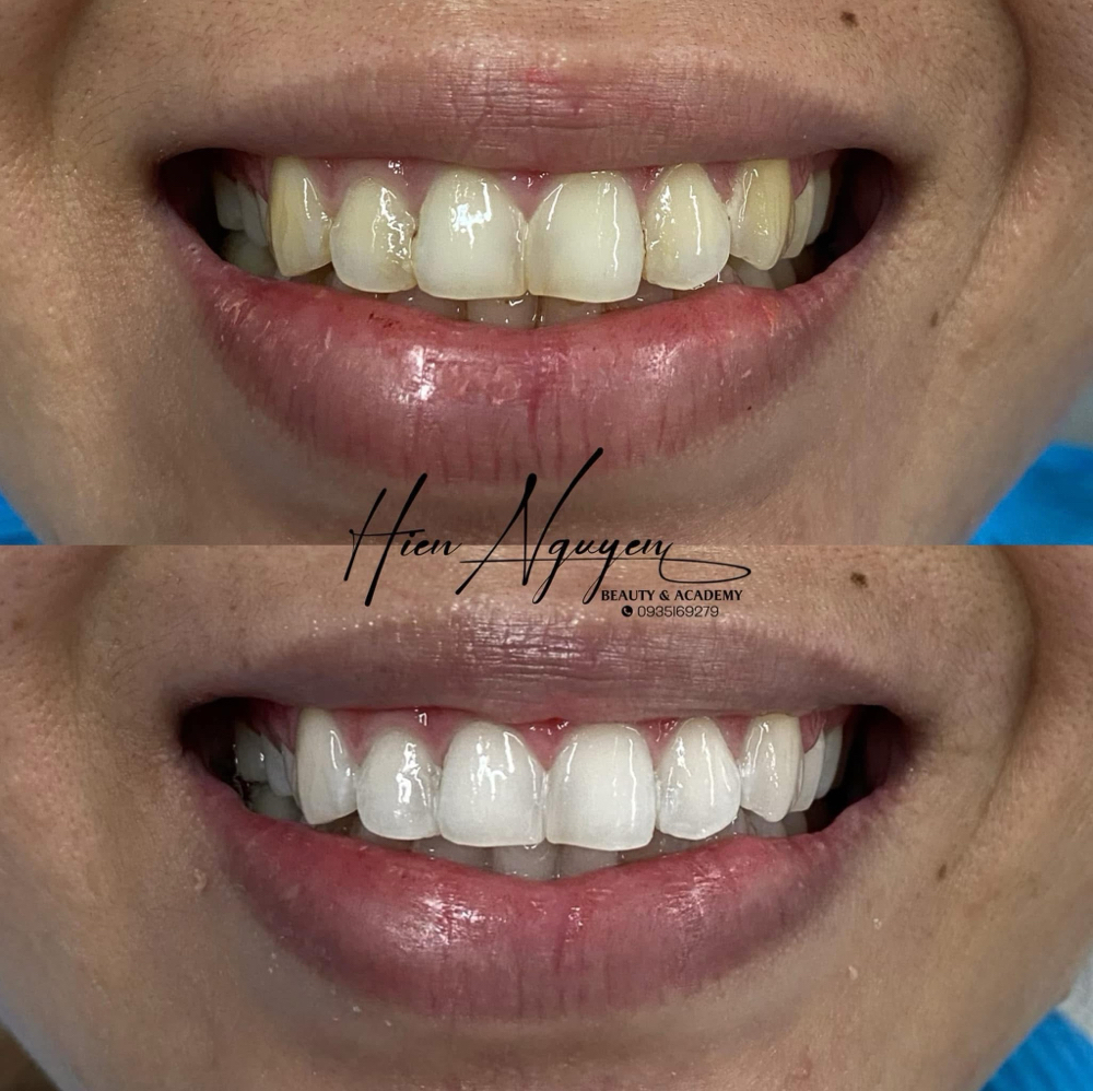 Teeth Whitening at Hynbeauty brows&lashes in Katy, TX