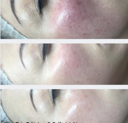 RED-APAX BioFacial at AV Esthetique in Highland Park, IL