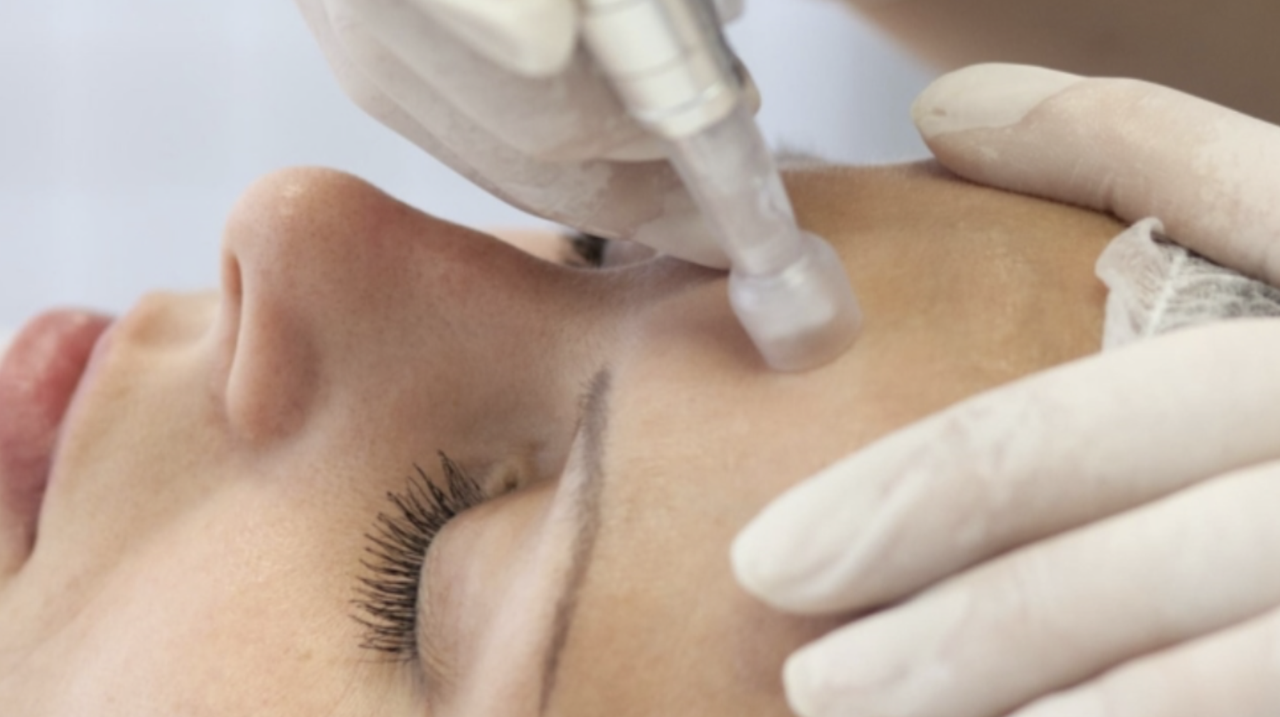 Microneedling with PRP (Face)