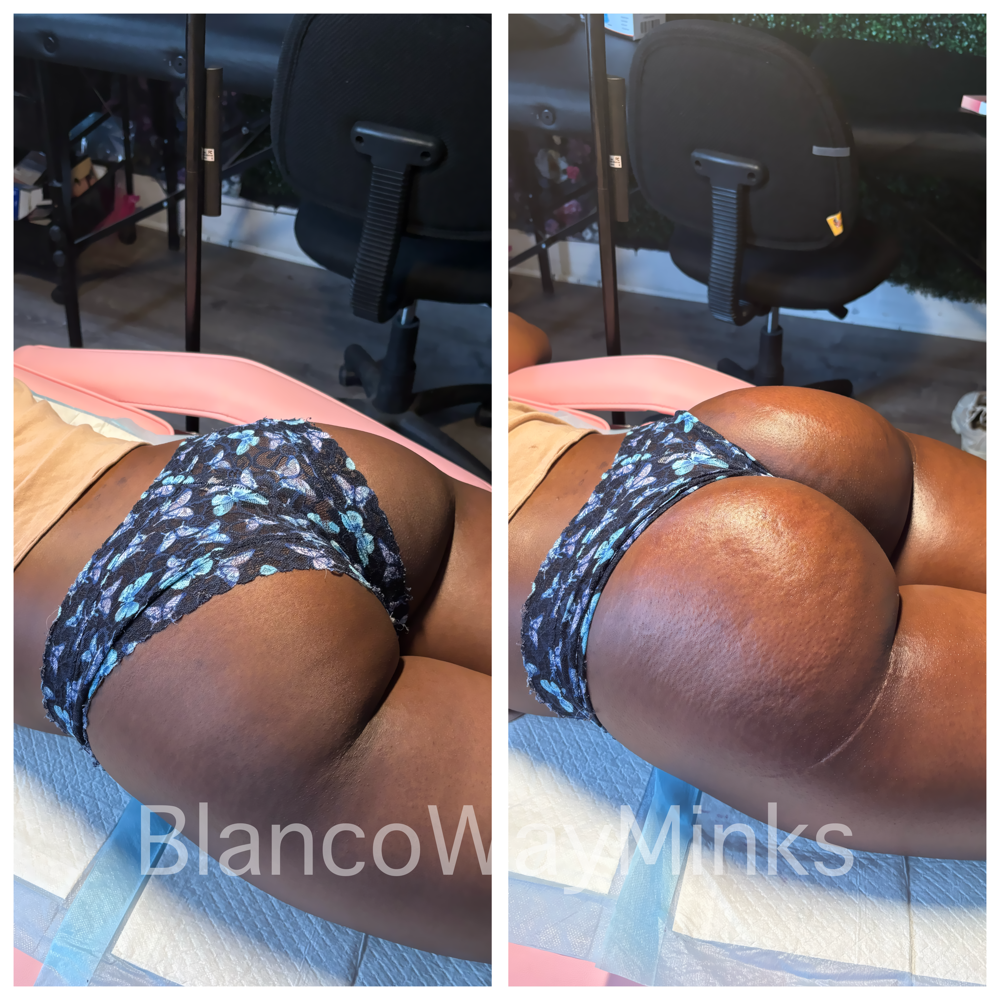 Vacuum Butt Lift