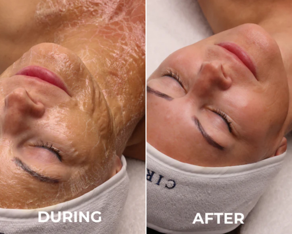 *4 Session* Beyond Botox