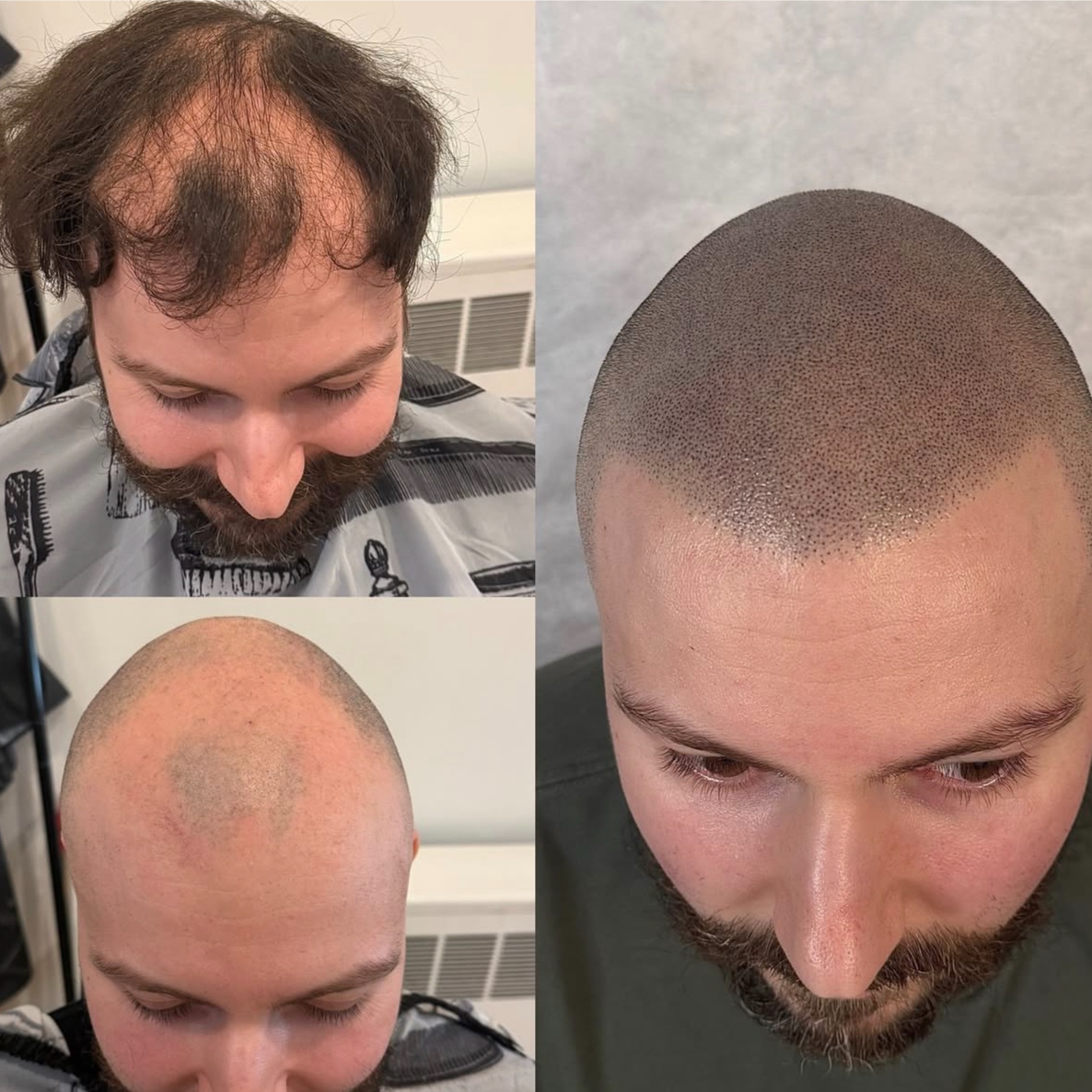 Scalp Pigmentation at Certified permanent makeup services in Newport Beach in Newport Beach, CA