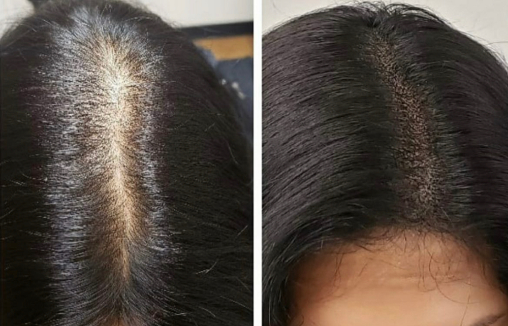 Scalp Micropigmentation