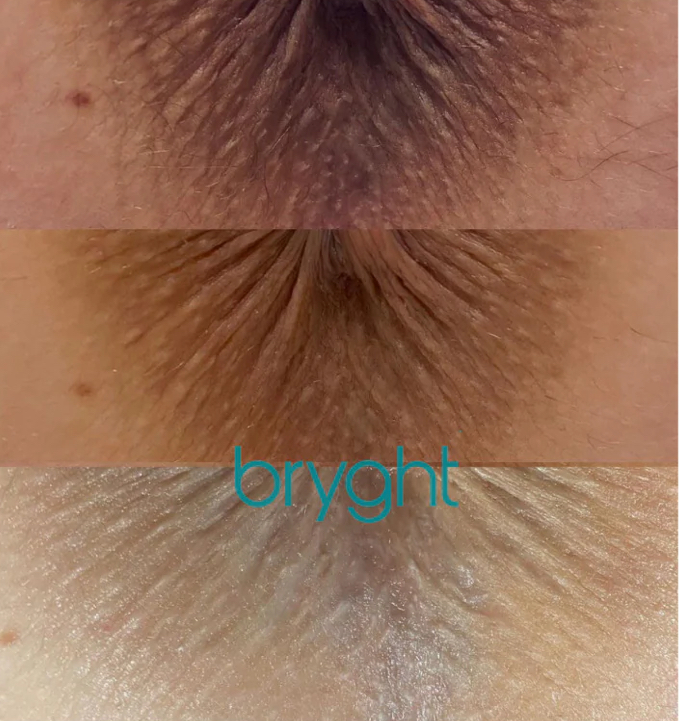 Intimate Bleaching-Anal/Buttocks