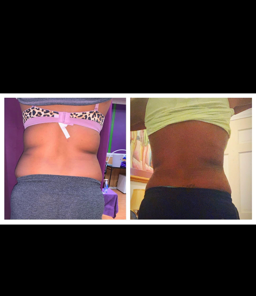 Back Injections