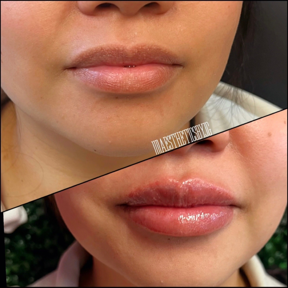 Lip Filler:1/2 Syringe