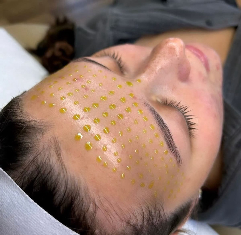 Chemical Peel Facial