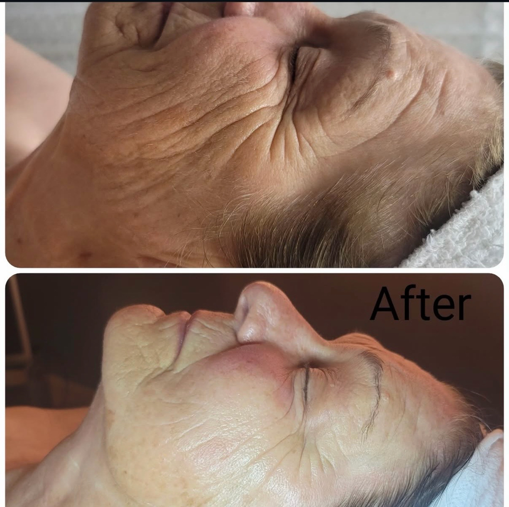 Jet Plasma Facial at The Wax Room in Midlothian, VA