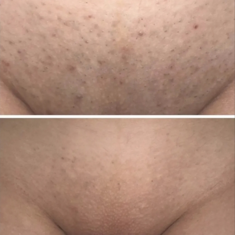 Brazilian LASER at BELLALOTOMH beauty lash studio in Beltsville, MD