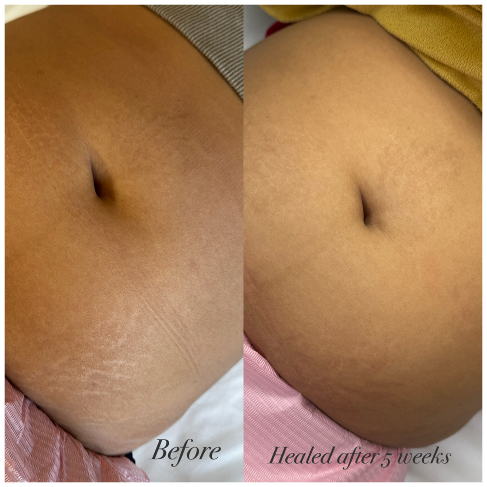 Inkless(Stretch Mark)pick 1 Area at Jane Rozier Permanent Makeup & Esthetics in Bellevue, NE