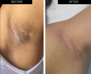 Intimate Skin Brightening