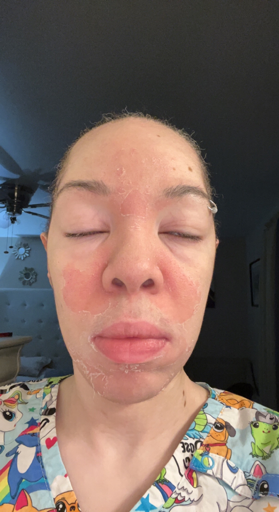 Advance Chemical Peel