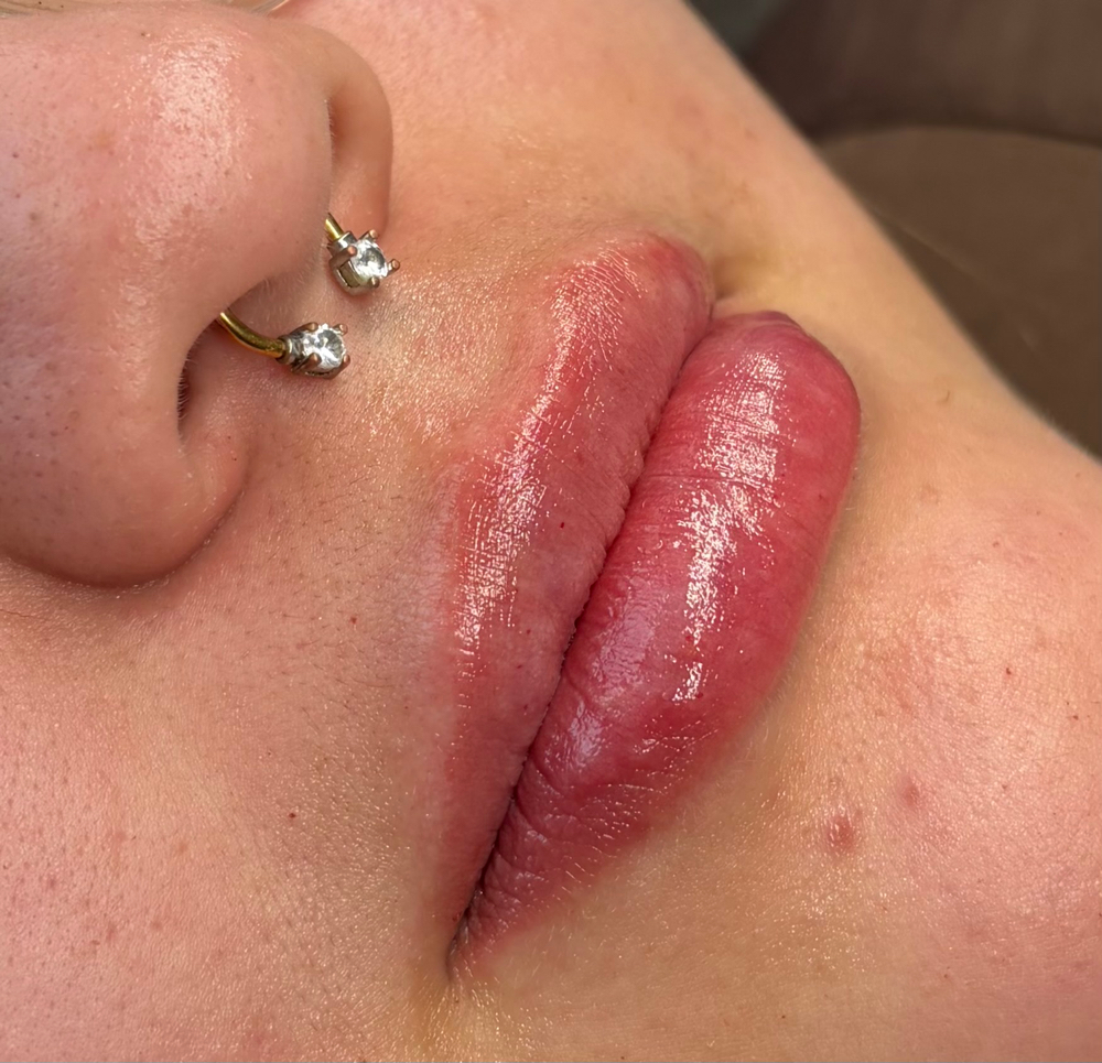 1ml Filler at Punchy Pouts & Esthetics in Amarillo, TX