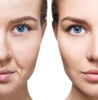 Biostimulators (Sculptra)