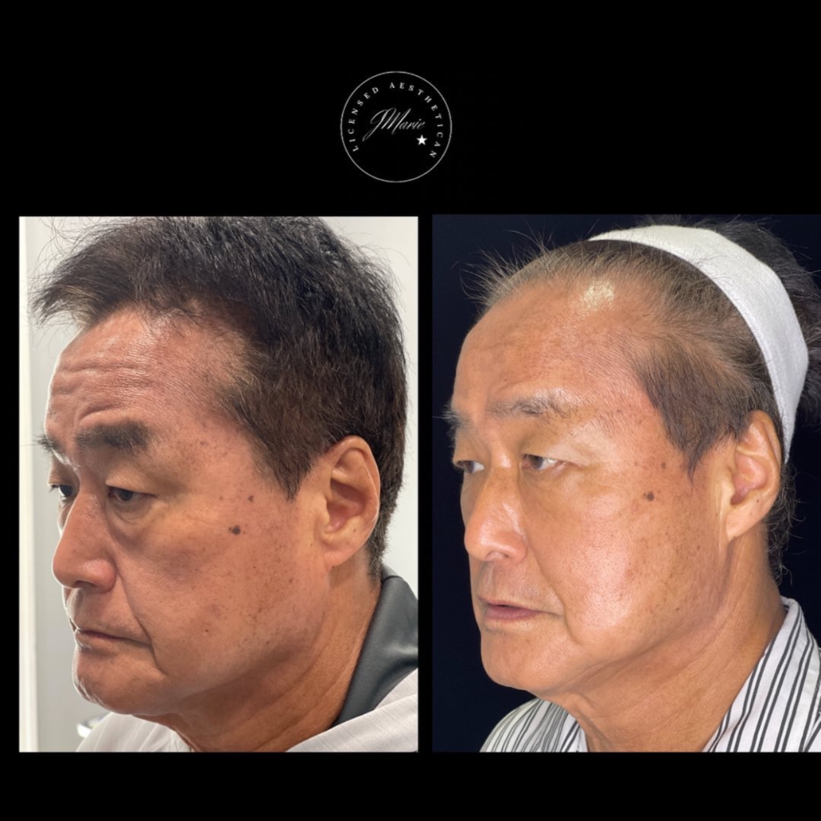 Jawline contour + lift at Corrective treatments + professional skincare in Atlanta, GA