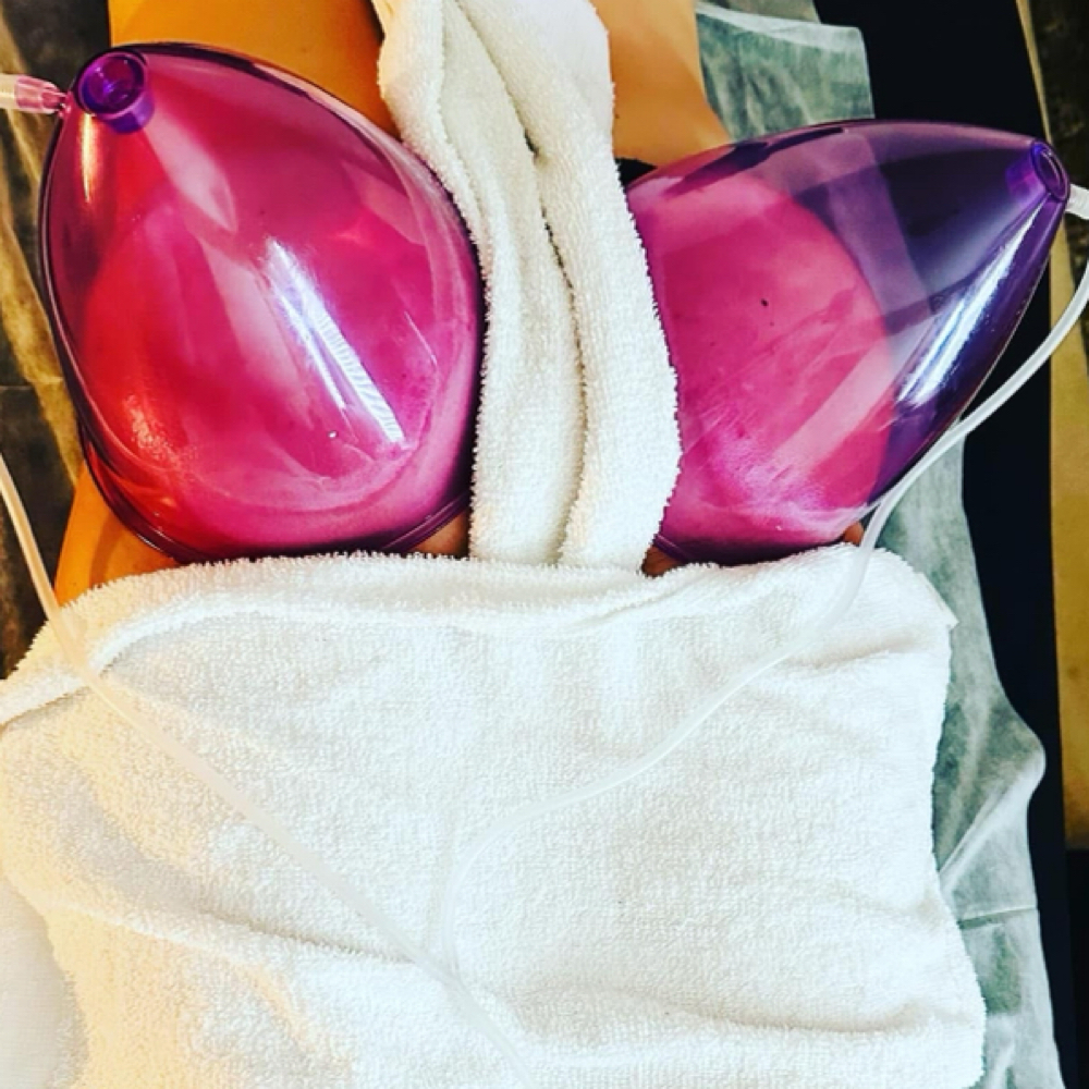Brazilian butt lift at Silhouette Body Sculpting LLC in St. Peter’s, MO