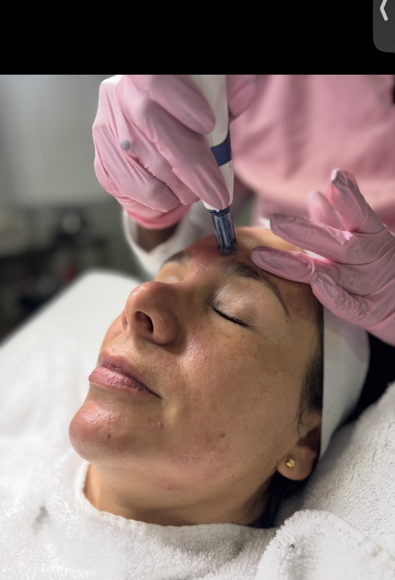 Induction therapy - Microneedling at Windys Beauty Studio LLC in Virginia Beach, VA