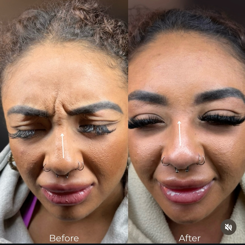 Tox - Glabella (Between Eyes)