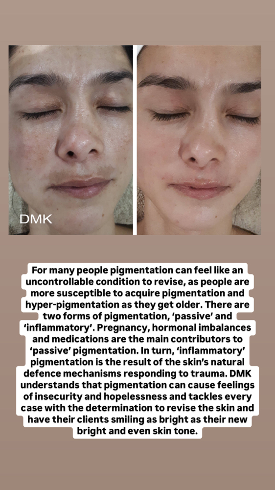 DMK/Hyperpigmentation Consult