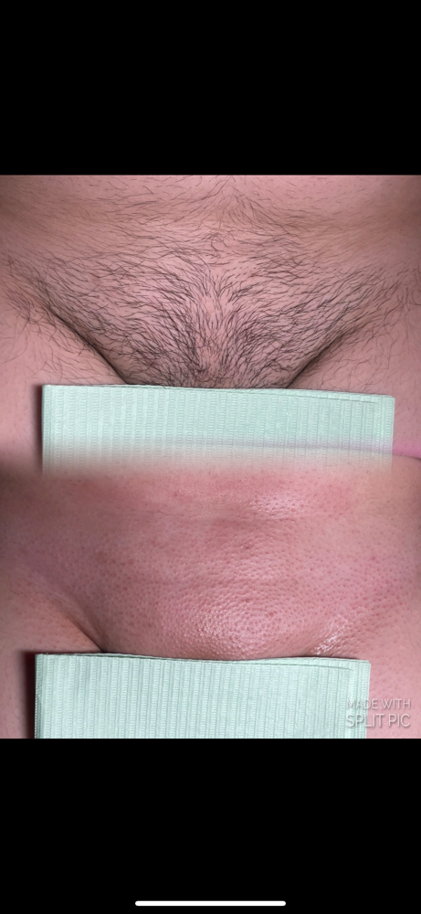 Brazilian Wax