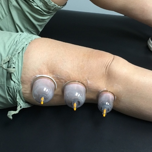 Targeted Cupping Enhancement at Riverbend Massotherapy in Sandusky, OH