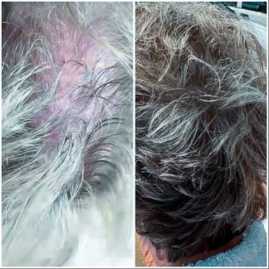 ReVéLux™ Hair Restore at SKIN PERFECT in CARTERSVILLE, GA