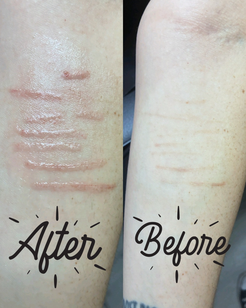 Self Harm Scar Camouflage