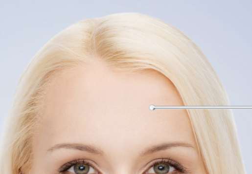 Plasma Fibroblast Forehead