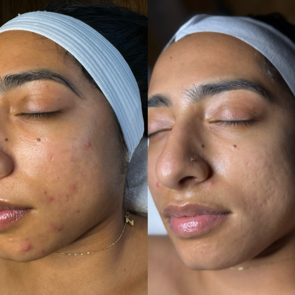 Acne Boot Camp (Returning Clients) at Oasiah Aesthetics in New York, NY
