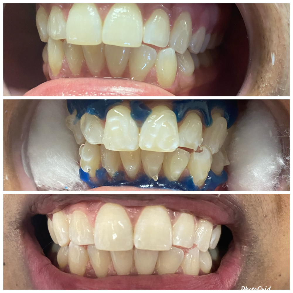 Sensitivity Treatment at Shaqs Teeth Whitening in Tarboro, NC