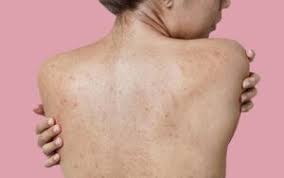 Back Acne Treatment