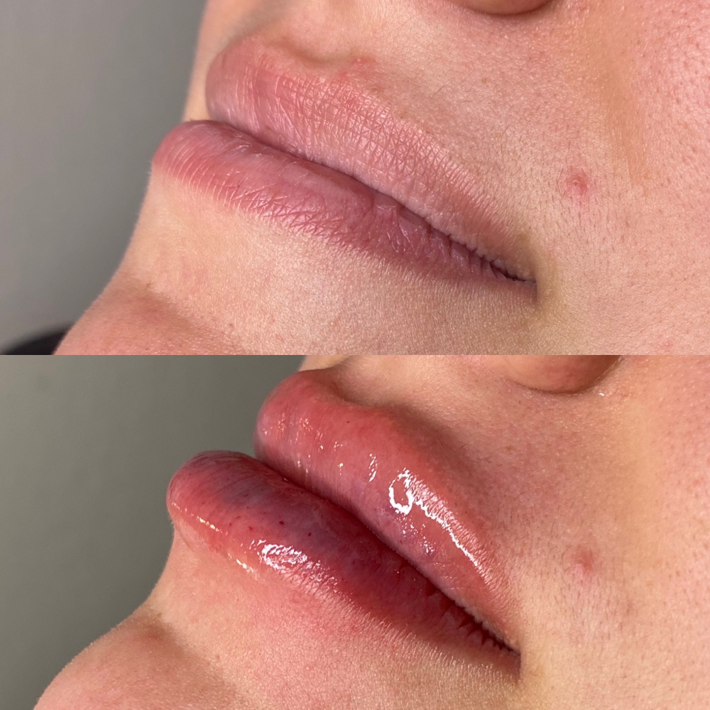 .5ML HA Lip Filler (Touch-Up ONLY)