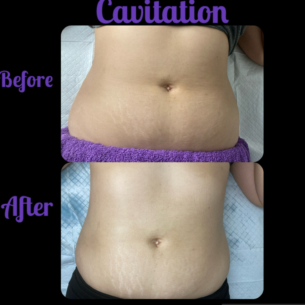 6 Cavitation Sessions at Glo’s Beauty Creations