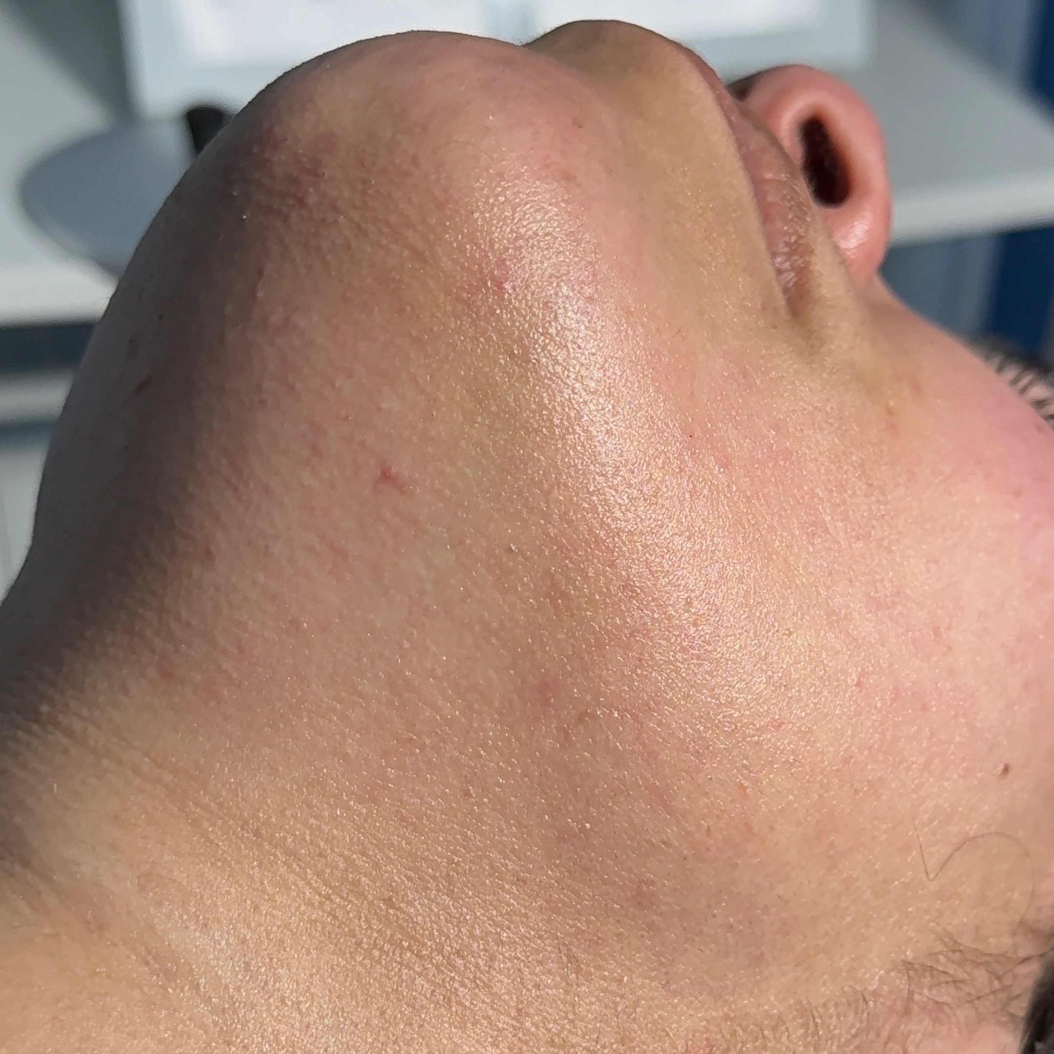 Chin wax at The Epilation Lab in New Britain, CT