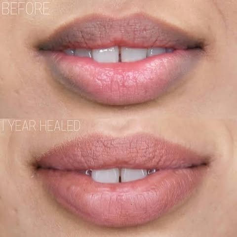 Lip Neutralization at Peridot Studio in Lubbock, TX
