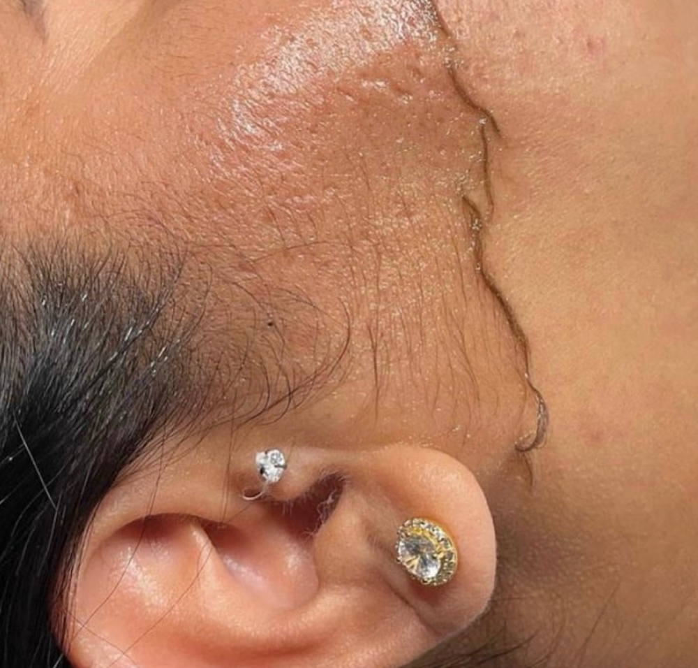 DERMAPLANE