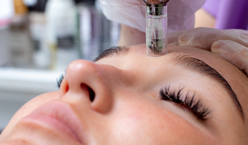 Microneedling Ze-Tox Effect