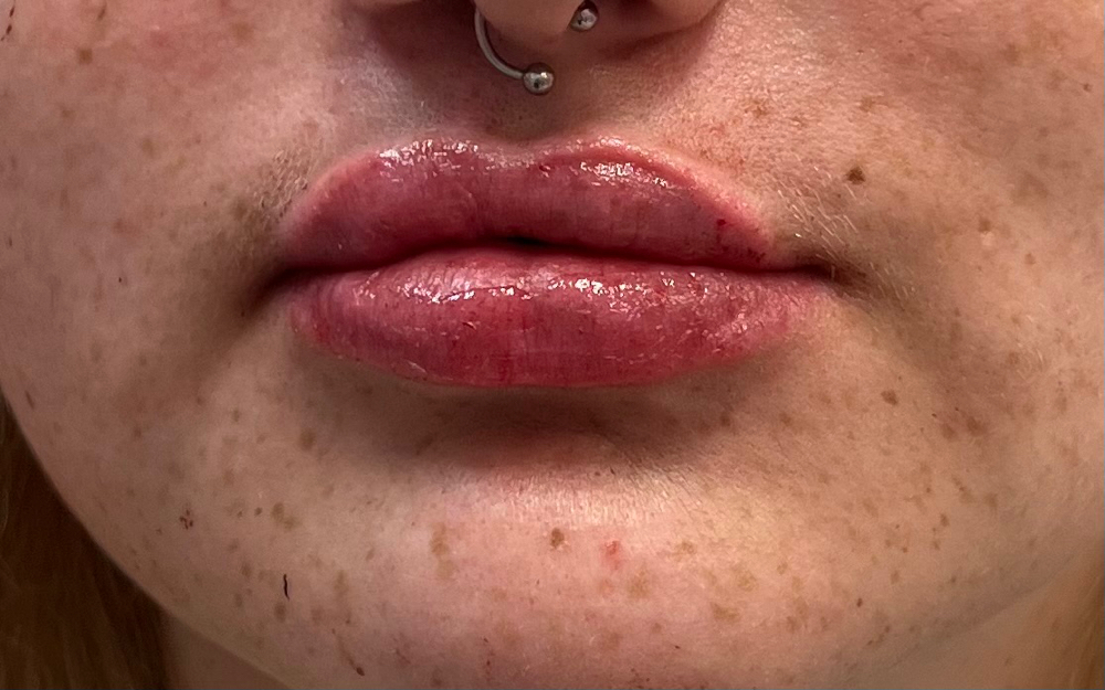 Lip Filler 1 Syringe