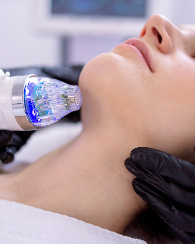 RF-Microneedling Face & Neck at M.A.V Aesthetics in Fort Morgan, CO