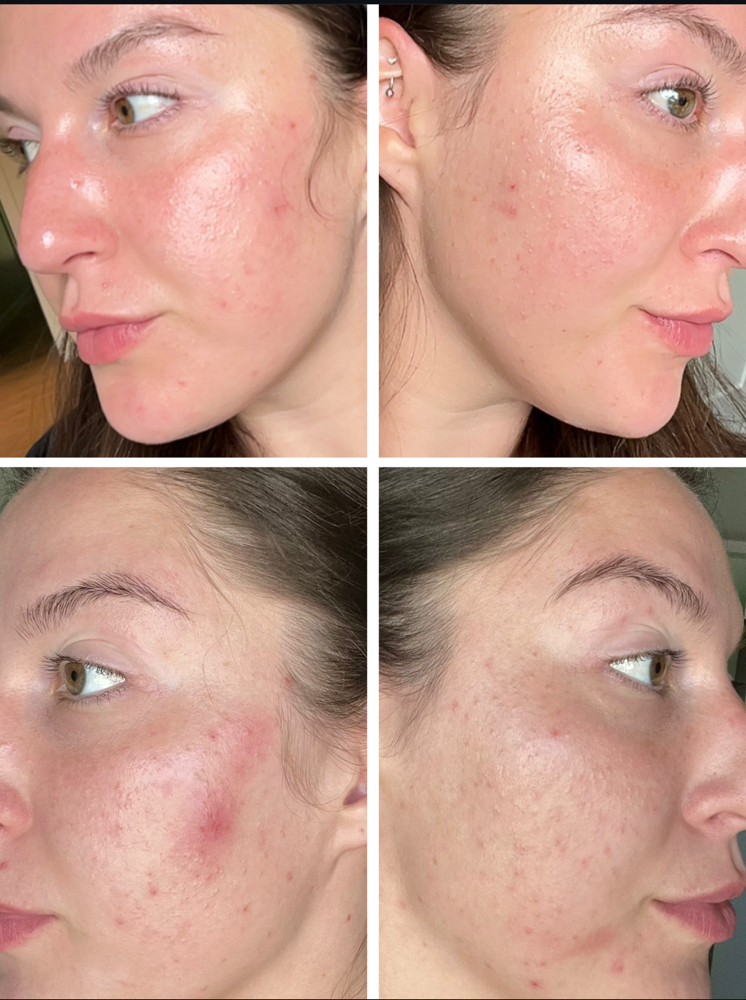 BioRe Peel (Chemical Peel) at Revital Med Aesthetics & Wellness in Oceanside, NY