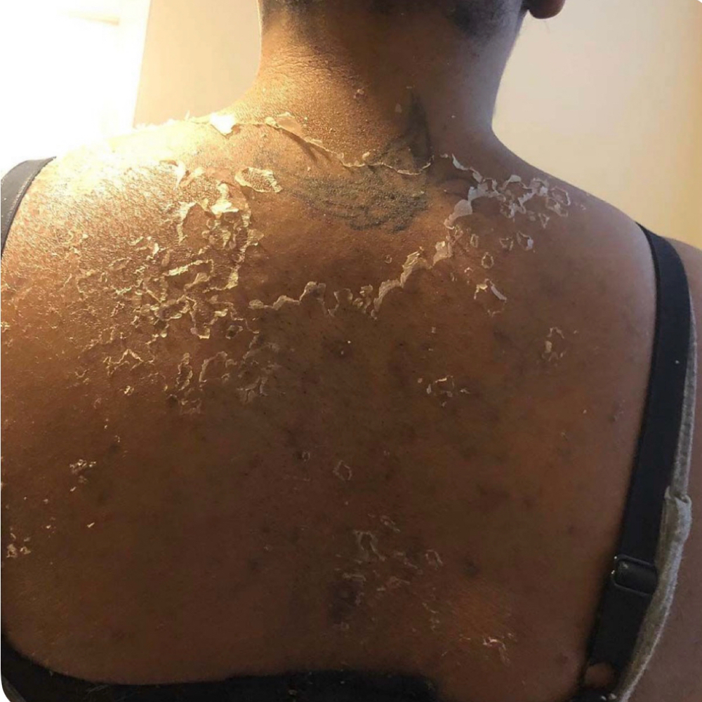 Back Renewal Peel at Nyah Simone Spa in Garden City, NY