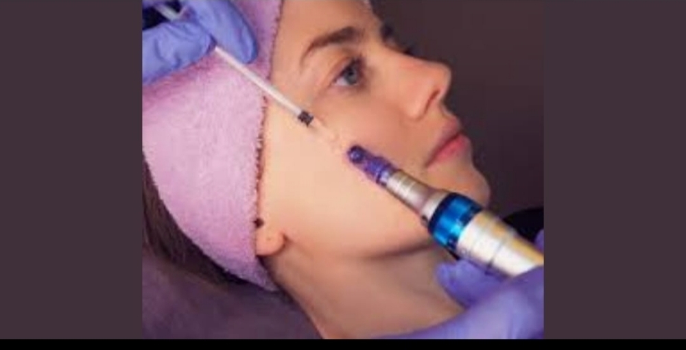 MICRO-NEEDLING  TREATMENT