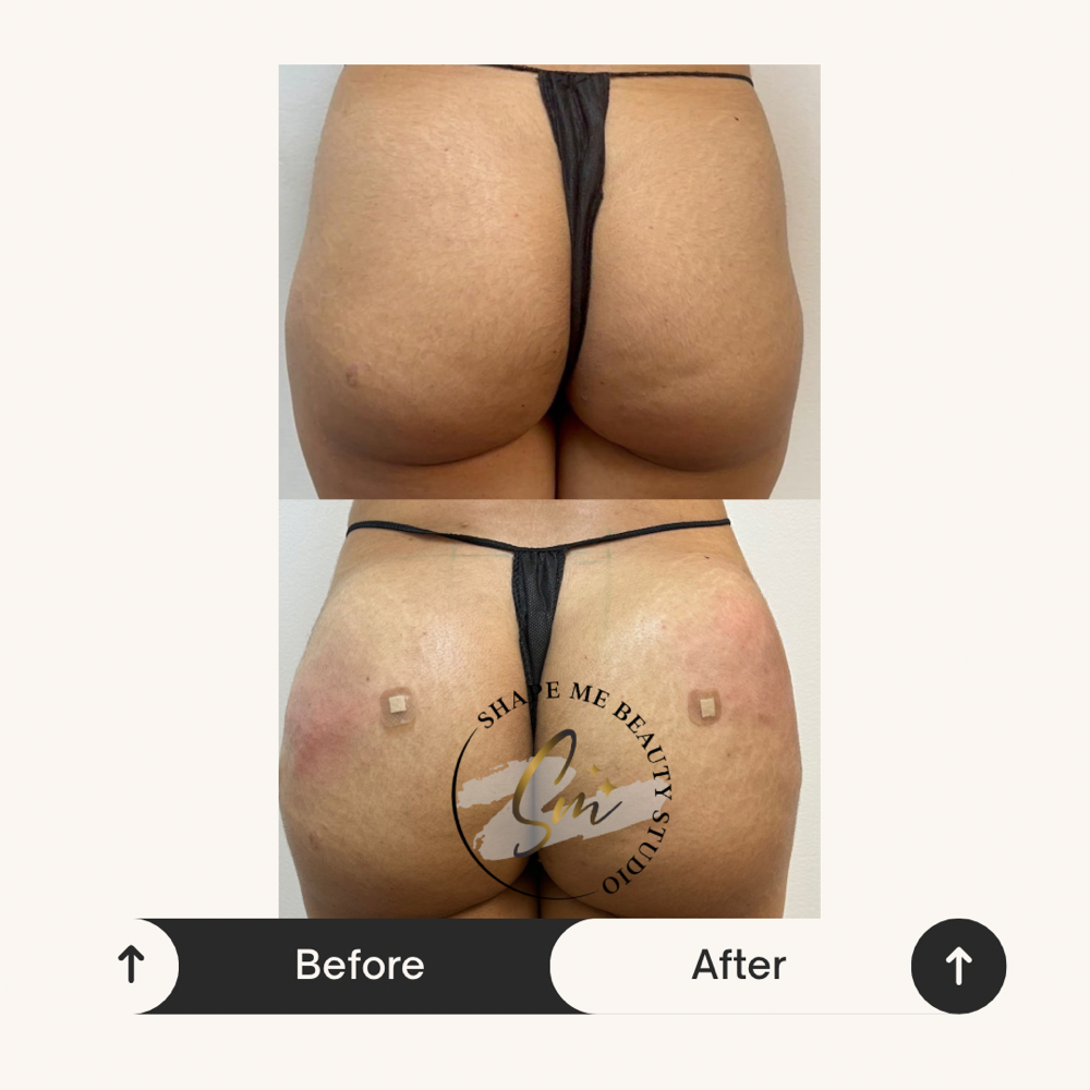 Liquid BBL 300 cc at Shape Me Beauty Studio in Midland, TX