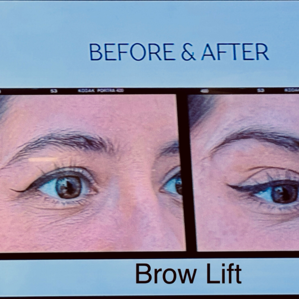 Brow Lift at Hypnotic Aesthetic in Lavon, TX