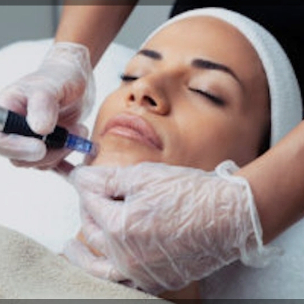 Microneedeling Special at let's face it by Ash in Evans, CO