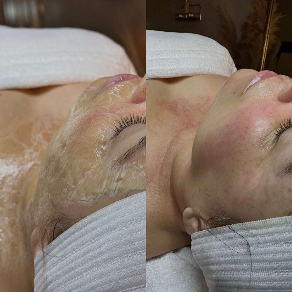 “Botox” In A Bottle Facial