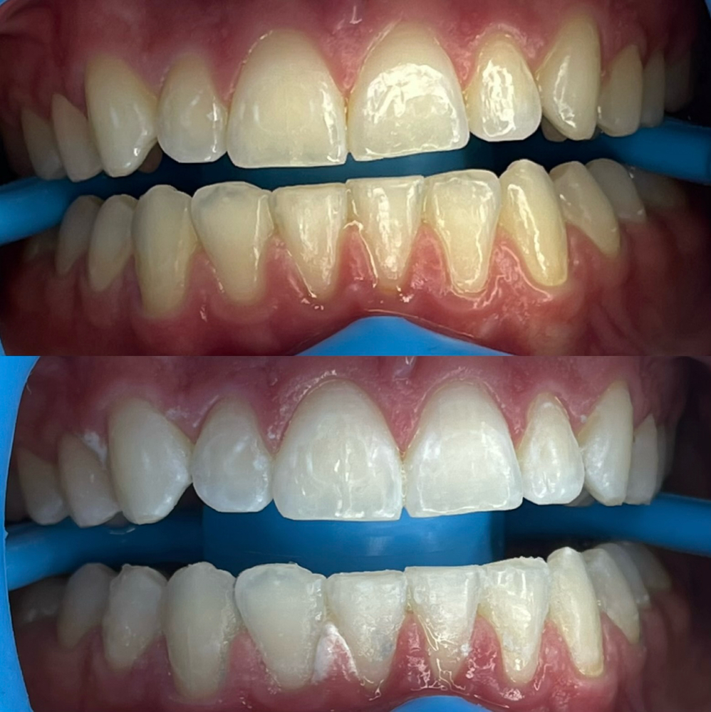 1 Hour Teeth Whitening